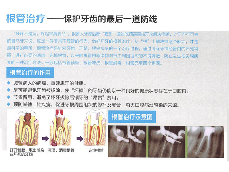 根管